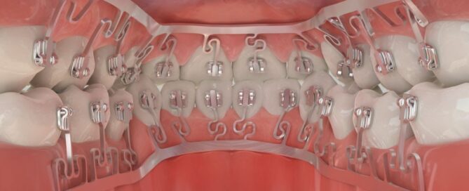 Everything you need to know about brius 3 A close-up of the inside of human mouth wearing inbrace orthodontic appliance