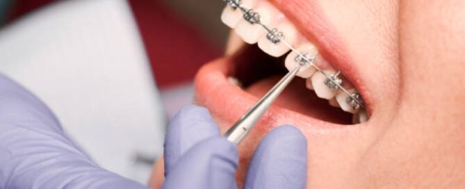 When do i get my braces off? 9 A close-up of a person's teeth when do i get my braces off?