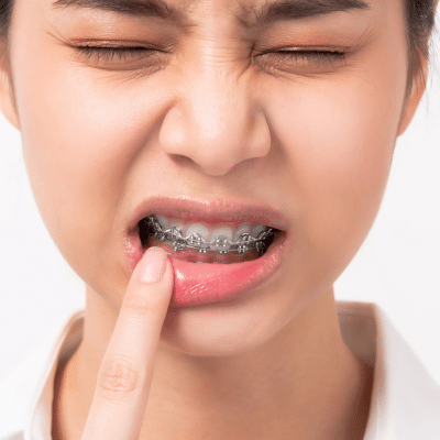Tips to relieve pain from braces and aligners 8 Person pressing finger on lip, experiencing pain with braces