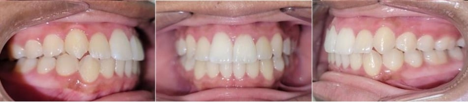 Insmile hidden braces 5 After photo of ariana’s smile showing straightened teeth and a more balanced bite after clear aligner therapy.