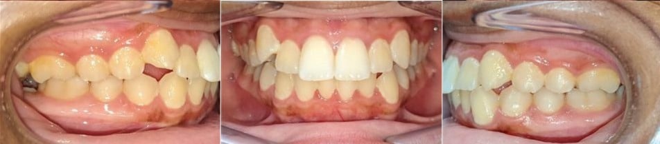 Insmile hidden braces 4 Before photo of ariana’s smile showing dental crowding and uneven alignment prior to orthodontic treatment.