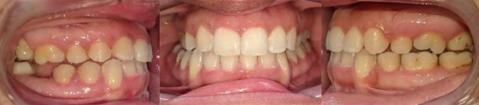 Before & afters 14 After photo of gianni’s smile showing even spacing, improved bite, and straight teeth after orthodontic care.