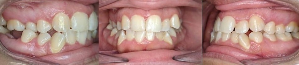 Before & afters 13 Before photo of gianni’s teeth showing overlapping and misaligned upper and lower arches.