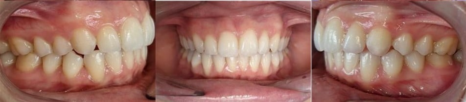 Before & afters 16 After photo of grace’s teeth showing well-aligned arches and an improved, uniform smile.