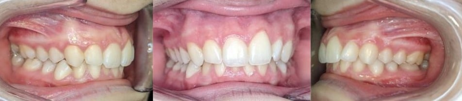 Before & afters 15 Before photo of grace’s teeth showing gaps and mild crowding before orthodontic correction.