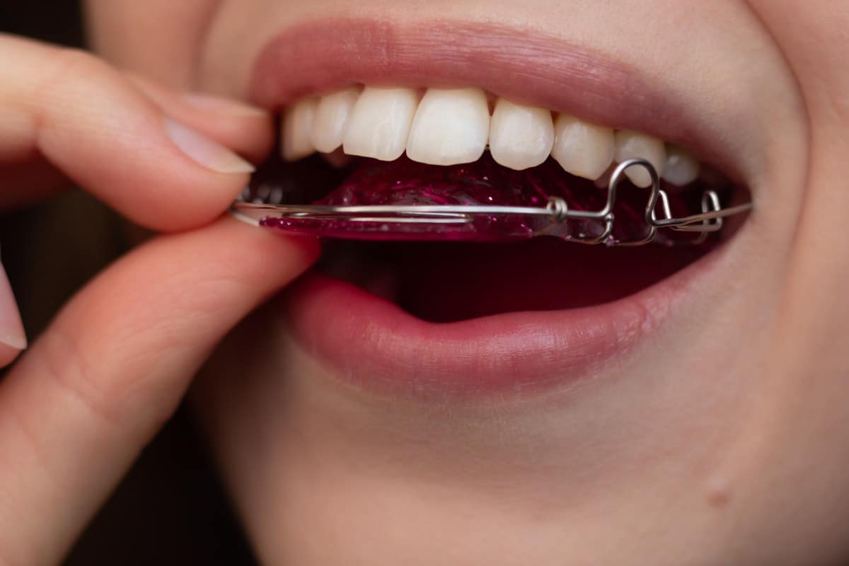 Close-up of a patient inserting a hawley retainer with a pink acrylic base and metal wire after orthodontic treatment.
