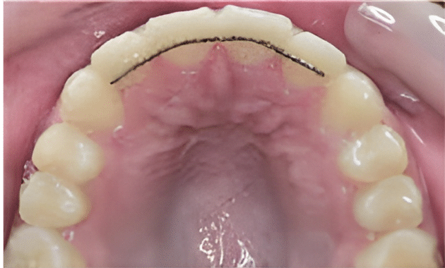 Close-up of a upper bonded retainer behind the teeth, used to maintain alignment after orthodontic treatment.