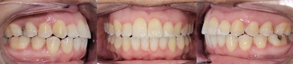 Insmile hidden braces 7 After photo of marissa’s smile with straightened teeth and improved bite alignment following clear aligner care.