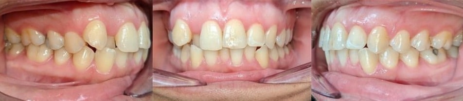 Insmile hidden braces 6 Before photo of marissa’s smile showing crowding and overlapping teeth prior to treatment.