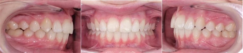 Insmile hidden braces 9 After photo of mia’s smile showing improved alignment, symmetry, and overall smile appearance.