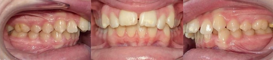 Insmile hidden braces 8 Before photo of mia’s smile showing moderate misalignment and bite irregularities before treatment.