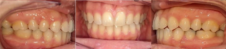 Before & afters 24 After photo of nahid’s smile showing improved alignment and smoother arch form after orthodontic treatment.