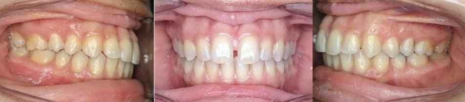 Before & afters 23 Before photo of nahid’s smile showing misaligned and crowded teeth prior to orthodontic care.