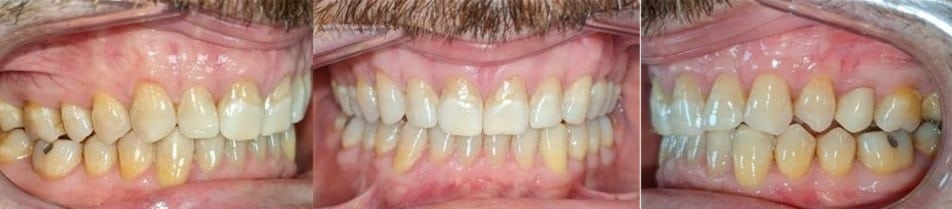 Before & afters 22 After photo of obaid’s smile showing even spacing, improved occlusion, and a brighter overall appearance.