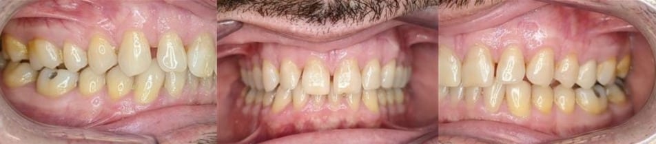 Before & afters 21 Before photo of obaid’s smile showing uneven spacing and mild bite misalignment.