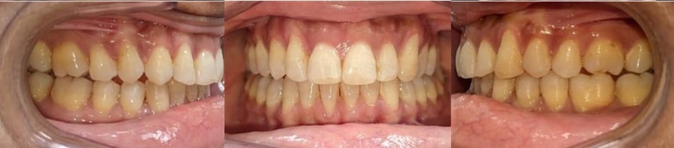 Before & afters 26 After photo of tanyu’s teeth showing straight, well-aligned arches and a balanced smile.