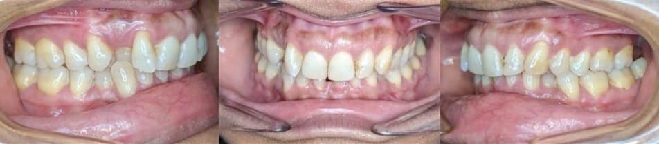 Before & afters 25 Before photo of tanyu’s teeth showing significant crowding and overlapping prior to orthodontic correction.