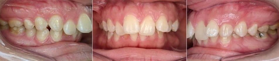 Before & afters 27 Before photo of vanessa’s teeth showing mild crowding and irregular spacing.