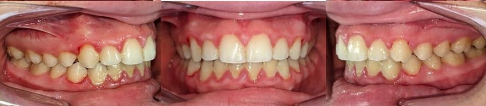 Before & afters 28 After photo of vaughn’s smile showing straightened, properly aligned teeth following treatment.