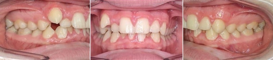 Before & afters 29 Before photo of vaughn’s smile showing overlapping teeth and crowding before orthodontic correction.