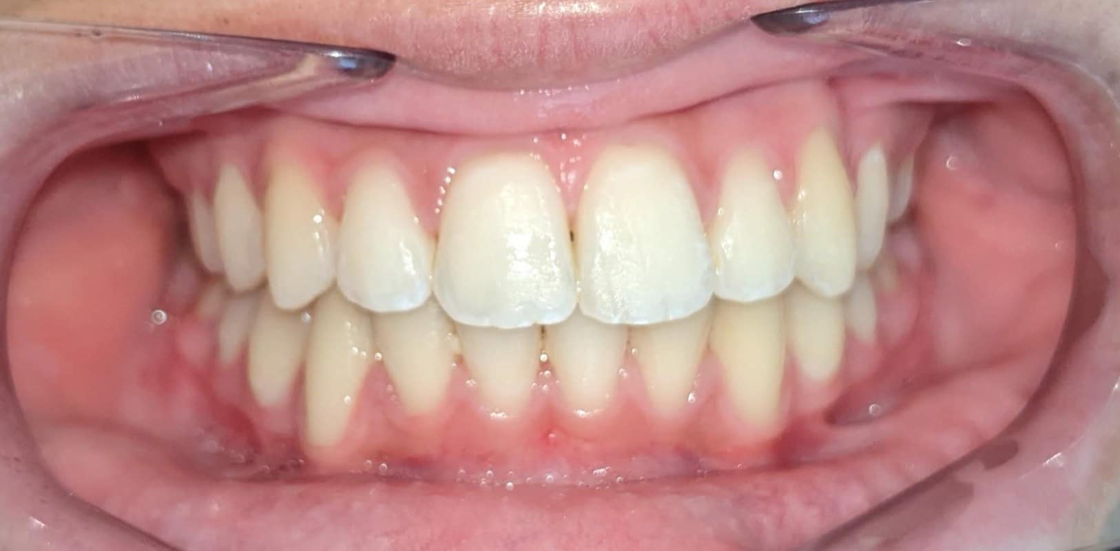 Hidden-smiles-makayla-final-smile After orthodontic treatment showing straightened teeth and a well-aligned, healthy smile.