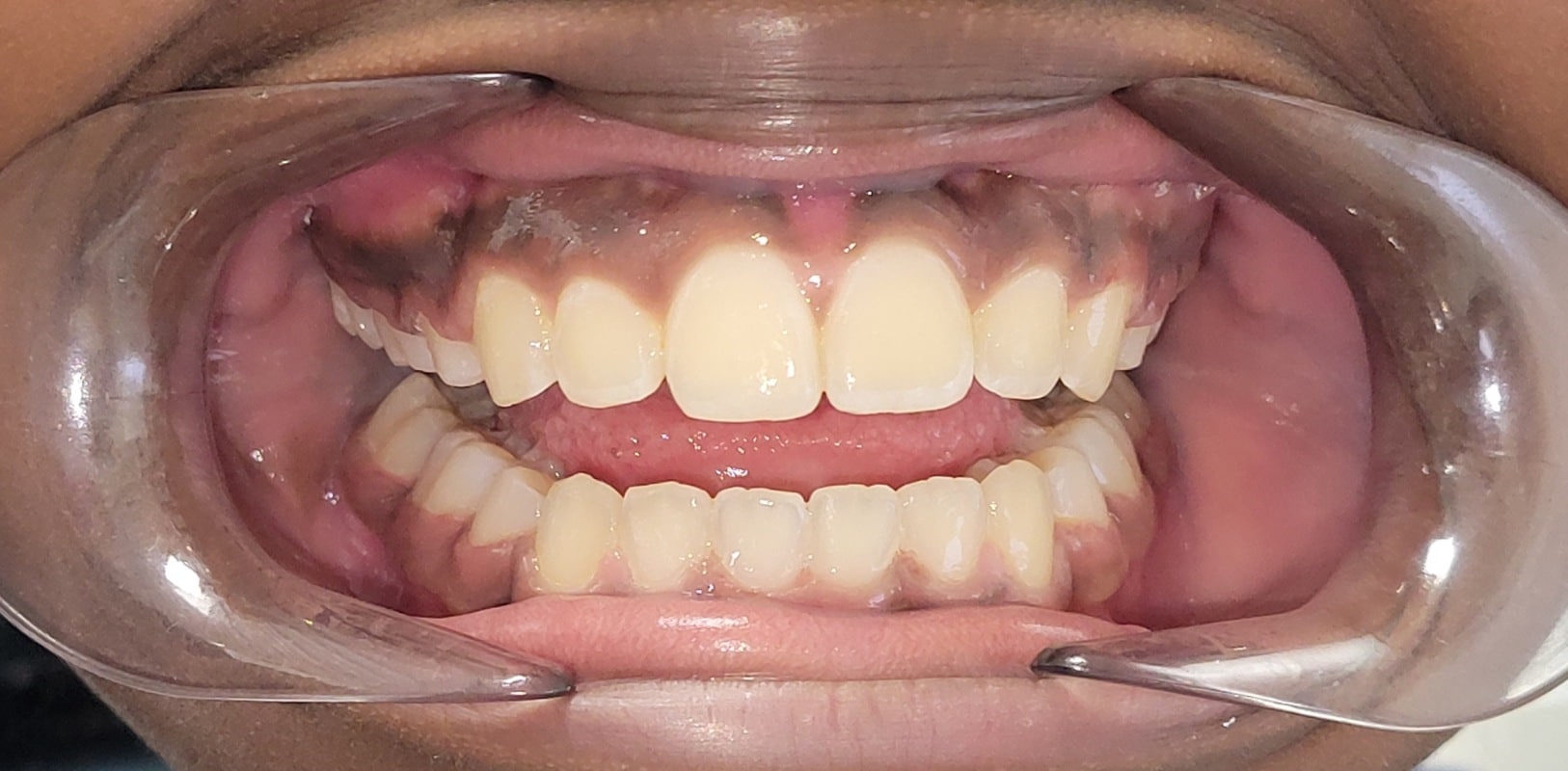 Hidden-smiles-olivia-final-smile After orthodontic treatment showing improved alignment and a balanced, healthy smile.