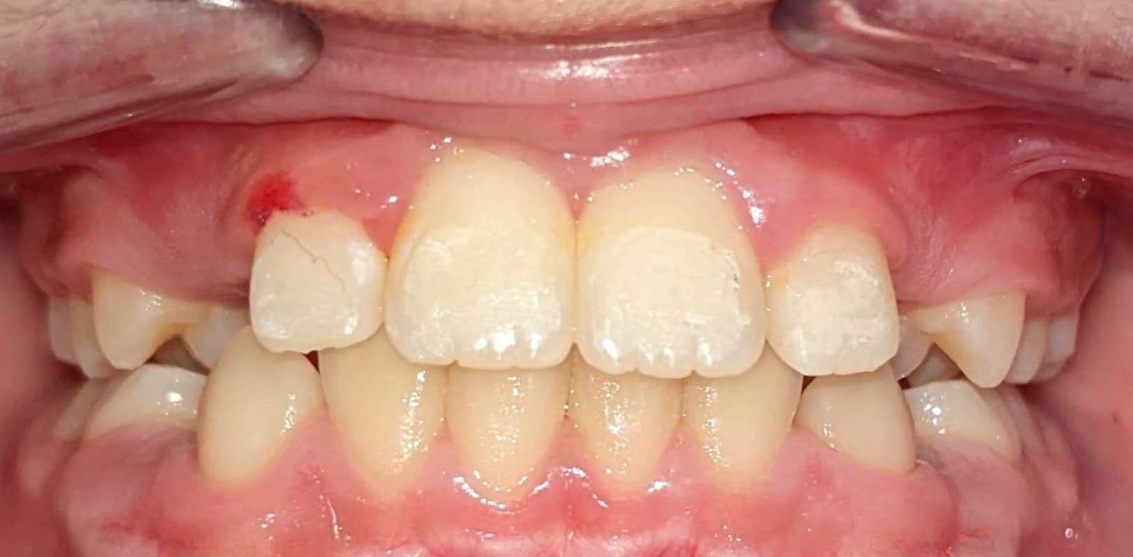 Before & afters 36 After orthodontic treatment showing improved alignment and a straight, balanced smile.