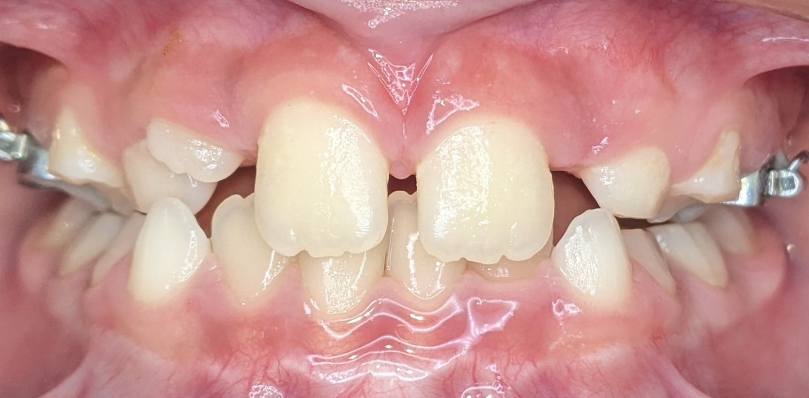 Before & afters 35 Before orthodontic treatment showing misaligned teeth and uneven spacing.