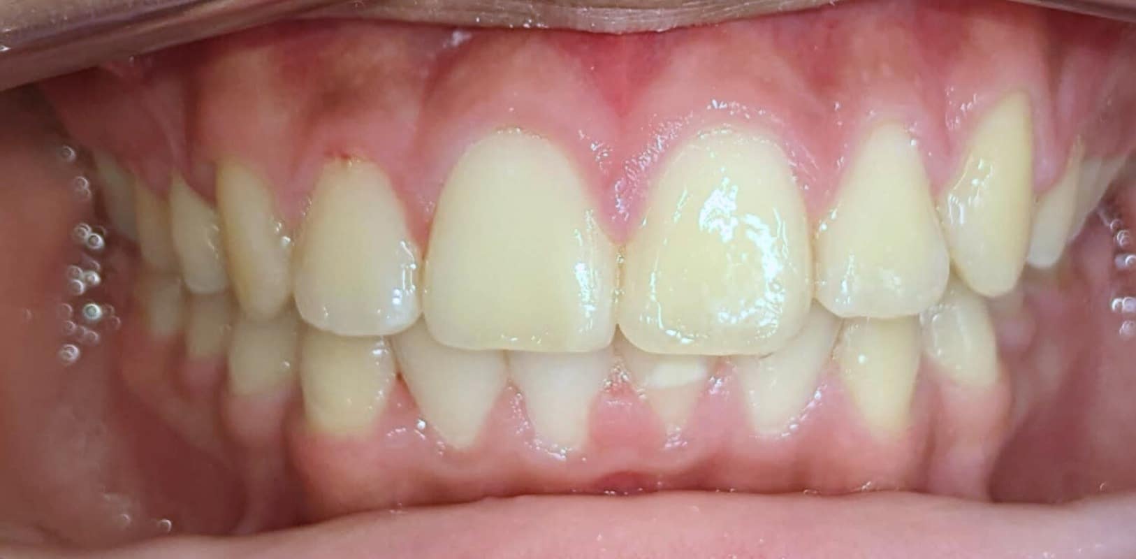 Before & afters 34 After orthodontic treatment showing improved alignment and a straight, balanced smile.