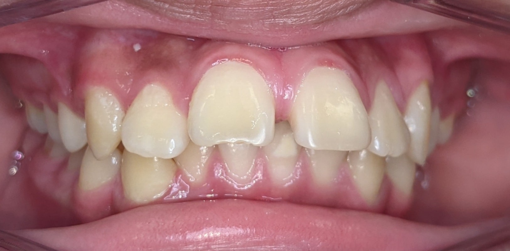 Before & afters 33 Before orthodontic treatment showing misaligned teeth and uneven spacing.