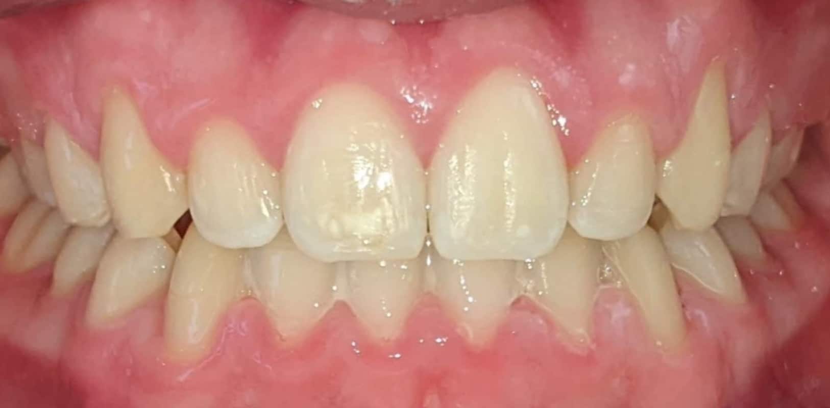 Before & afters 32 After orthodontic treatment showing improved alignment and a straight, balanced smile.
