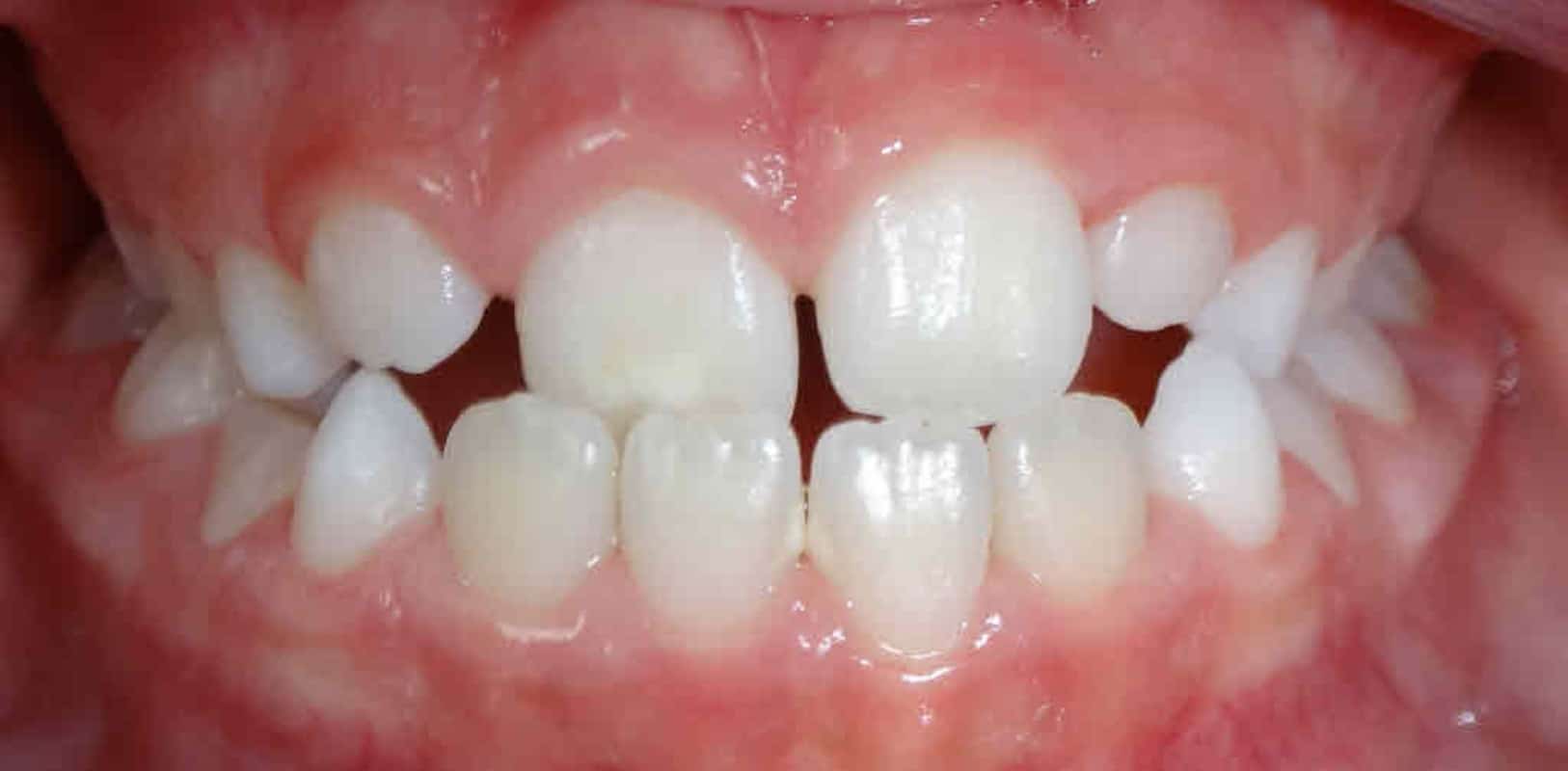 Before & afters 31 Before orthodontic treatment showing crowded teeth and misalignment prior to smile correction.