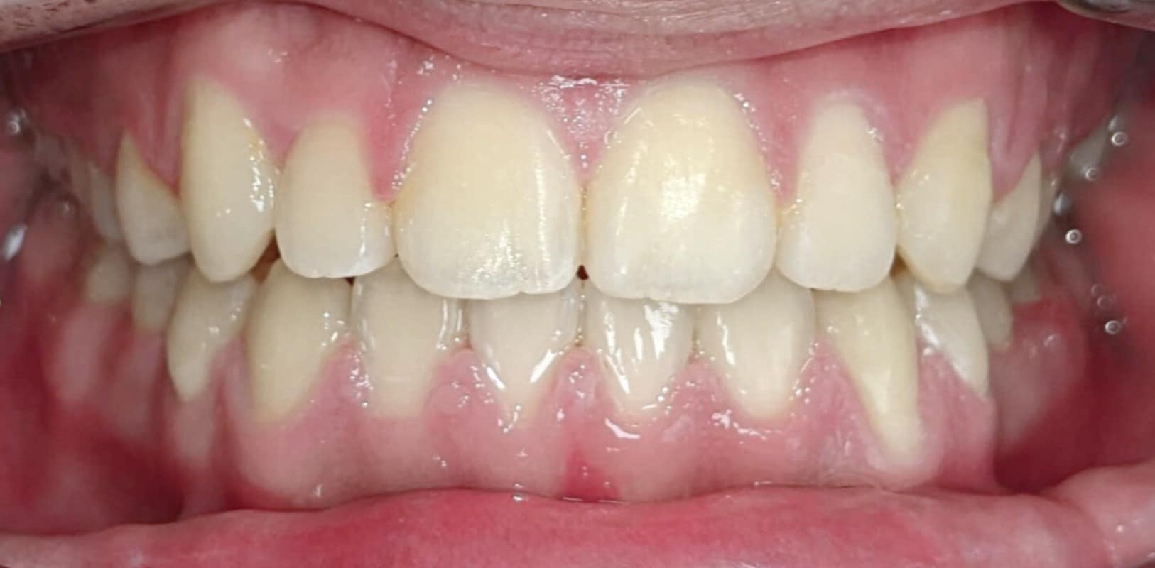 Before & afters 4 After orthodontic treatment with straight smile at hidden smiles in melville ny