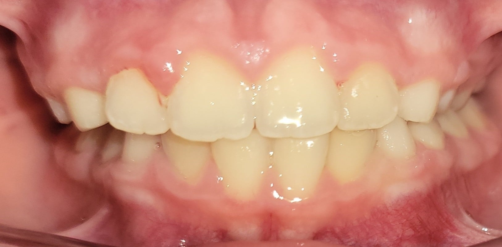 Before & afters 6 After braces treatment with improved alignment at hidden smiles in melville ny