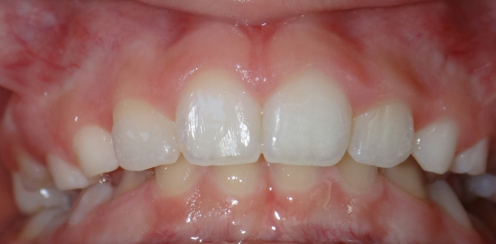 Before & afters 8 After invisalign treatment with straight teeth at hidden smiles in melville ny