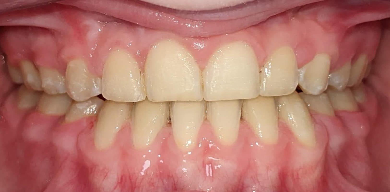 Before & afters 10 After orthodontic treatment with healthy aligned smile at hidden smiles in melville ny