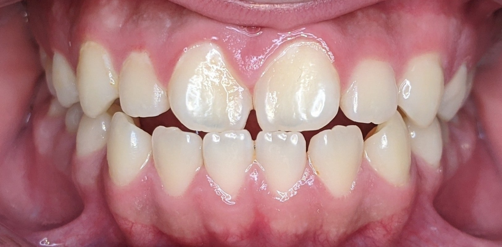 Before & afters 3 Before orthodontic treatment showing crowding and misalignment at hidden smiles orthodontics in raleigh nc
