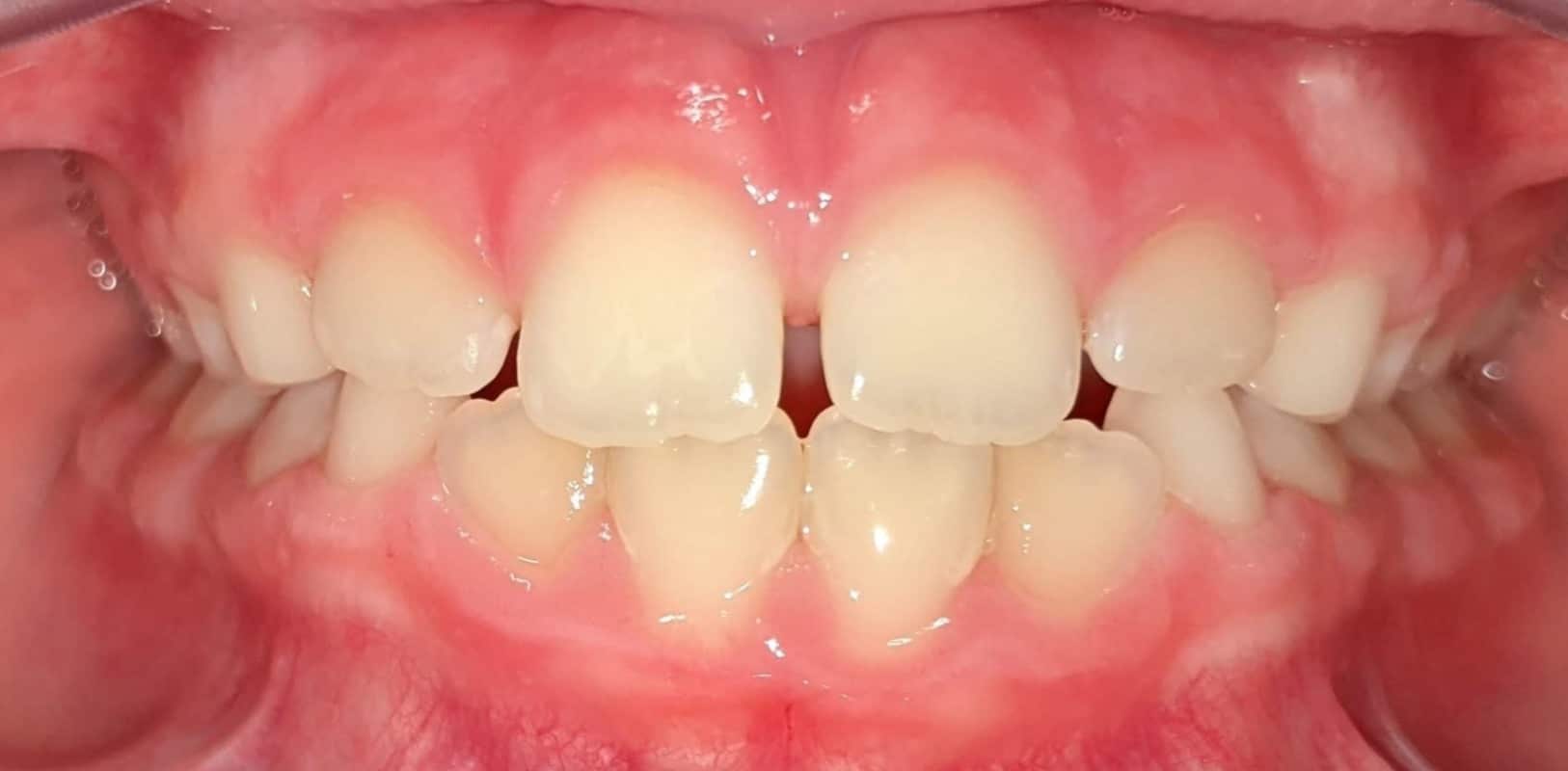 Before & afters 5 Before braces treatment showing crooked teeth at hidden smiles in melville ny