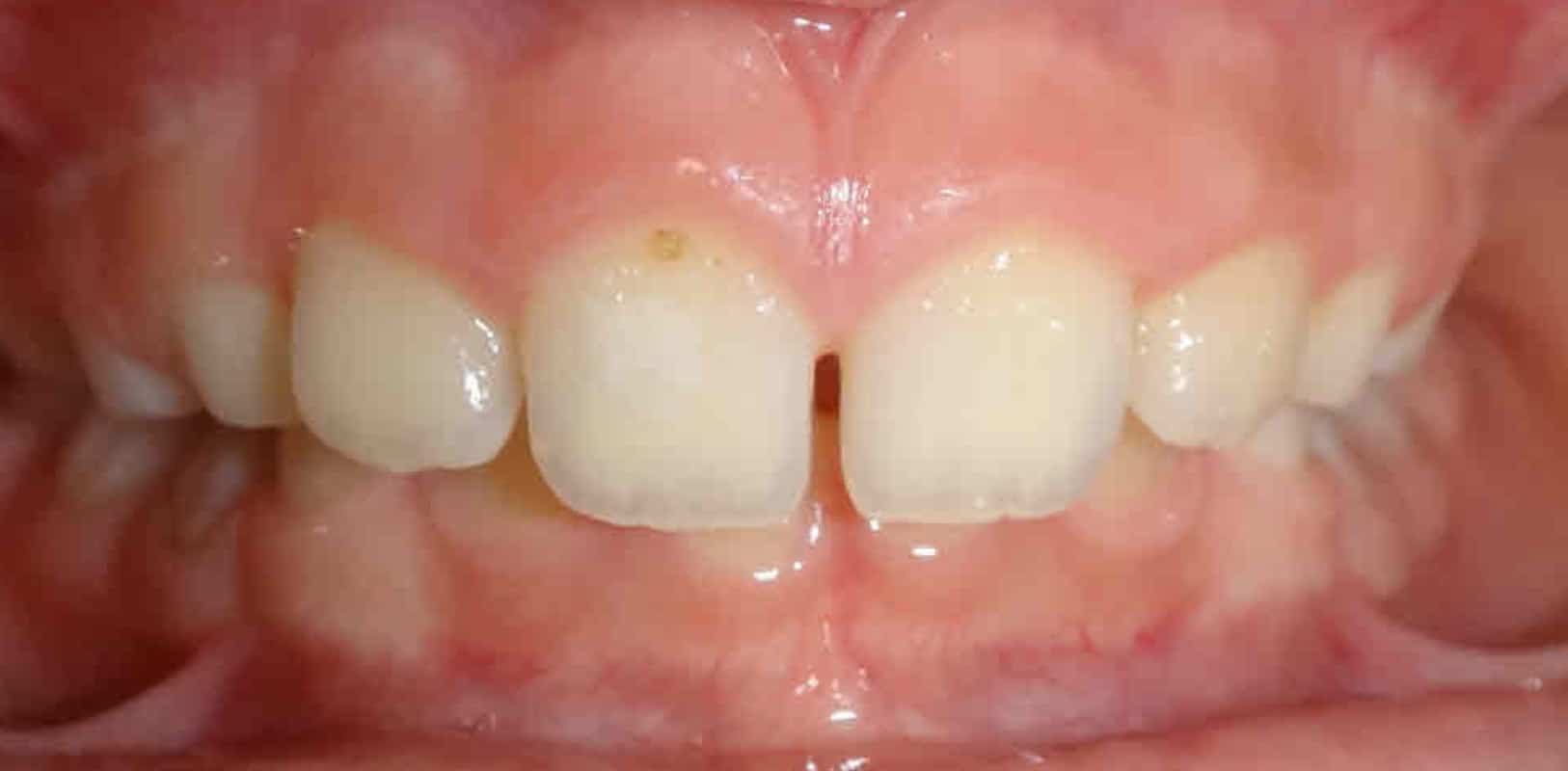 Before & afters 7 Before invisalign treatment showing spacing issues at hidden smiles in melville ny
