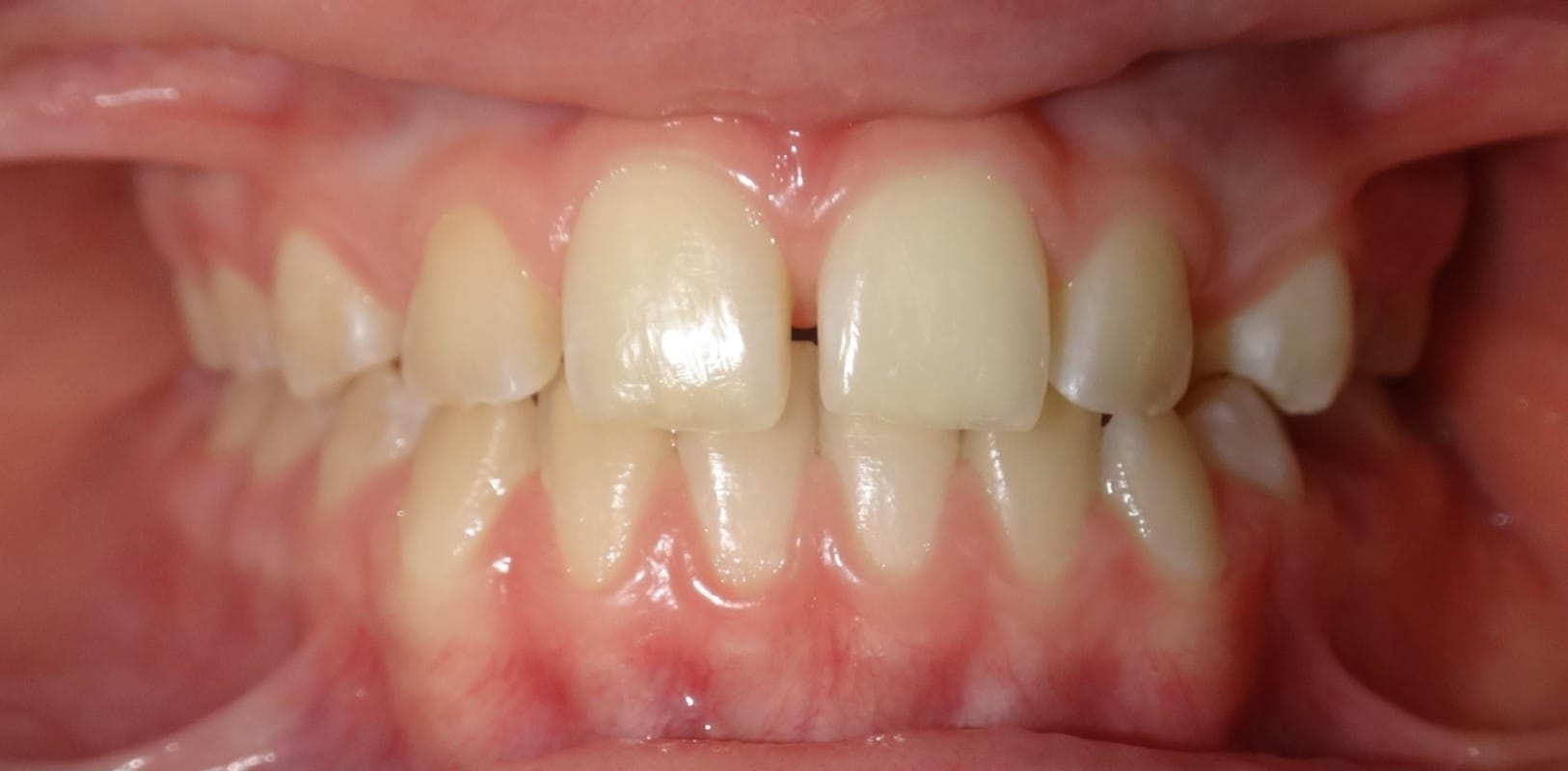 Before & afters 9 Before orthodontic treatment showing crowding at hidden smiles in melville ny