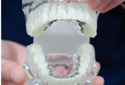 Lingual braces vs invisalign: which is right for your smile? 3 Model teeth with lingual braces demonstration, representing lingual braces vs invisalign
