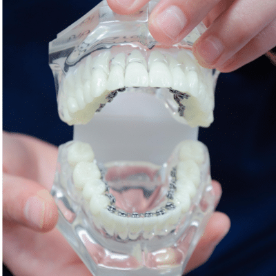 Lingual braces vs invisalign: which is right for your smile? 3 Model teeth with lingual braces demonstration, representing lingual braces vs invisalign