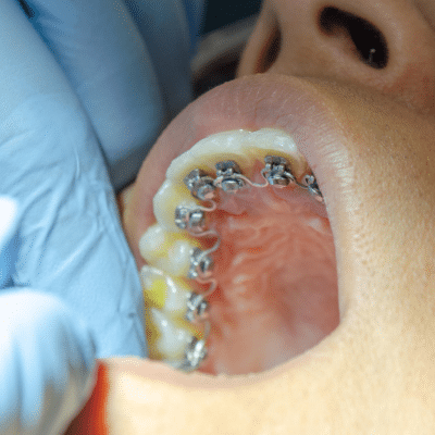 What are hidden braces? 3 Patient with mouth open, showing lingual braces behind the teeth, representing the question: what are hidden braces?