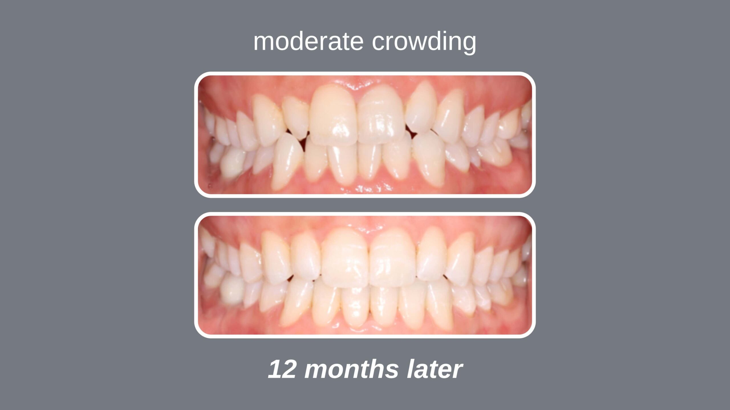 Before and after orthodontic treatment correcting moderate crowding with hidden braces at hidden smiles orthodontic studio