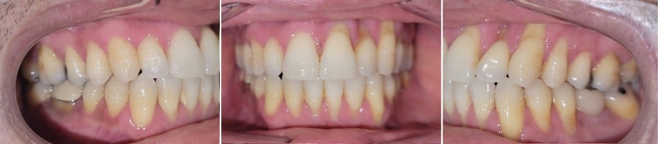 Insmile hidden braces 13 Before and after smile transformation using hidden braces at hidden smiles orthodontics