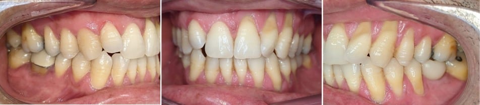 Insmile hidden braces 12 Before smile transformation using hidden braces at hidden smiles orthodontics