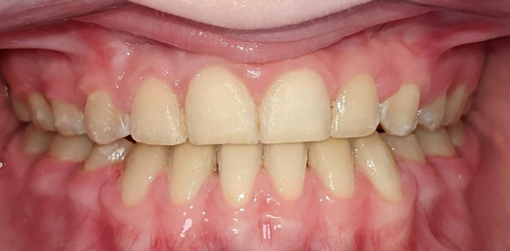 Metal braces 6 After orthodontic treatment showing improved alignment and smile development in a child patient