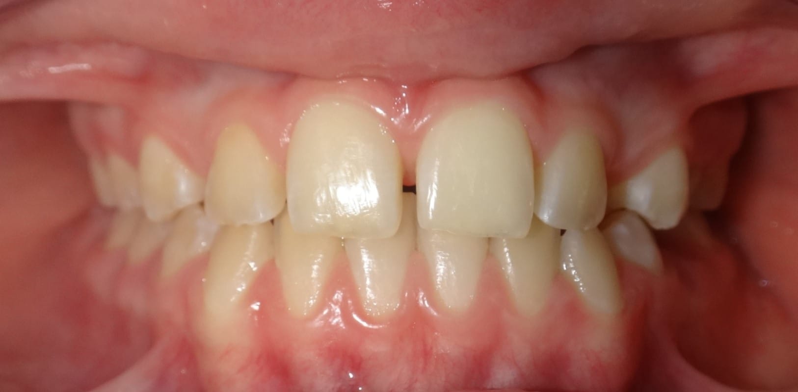 Metal braces 5 Before orthodontic treatment showing early alignment issues in a pediatric patient in new york