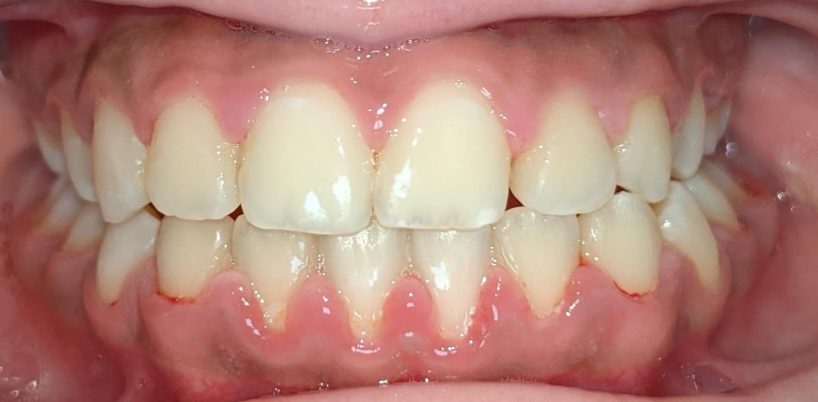 Metal braces 8 After braces treatment correcting crowding and bite alignment at hidden smiles orthodontics