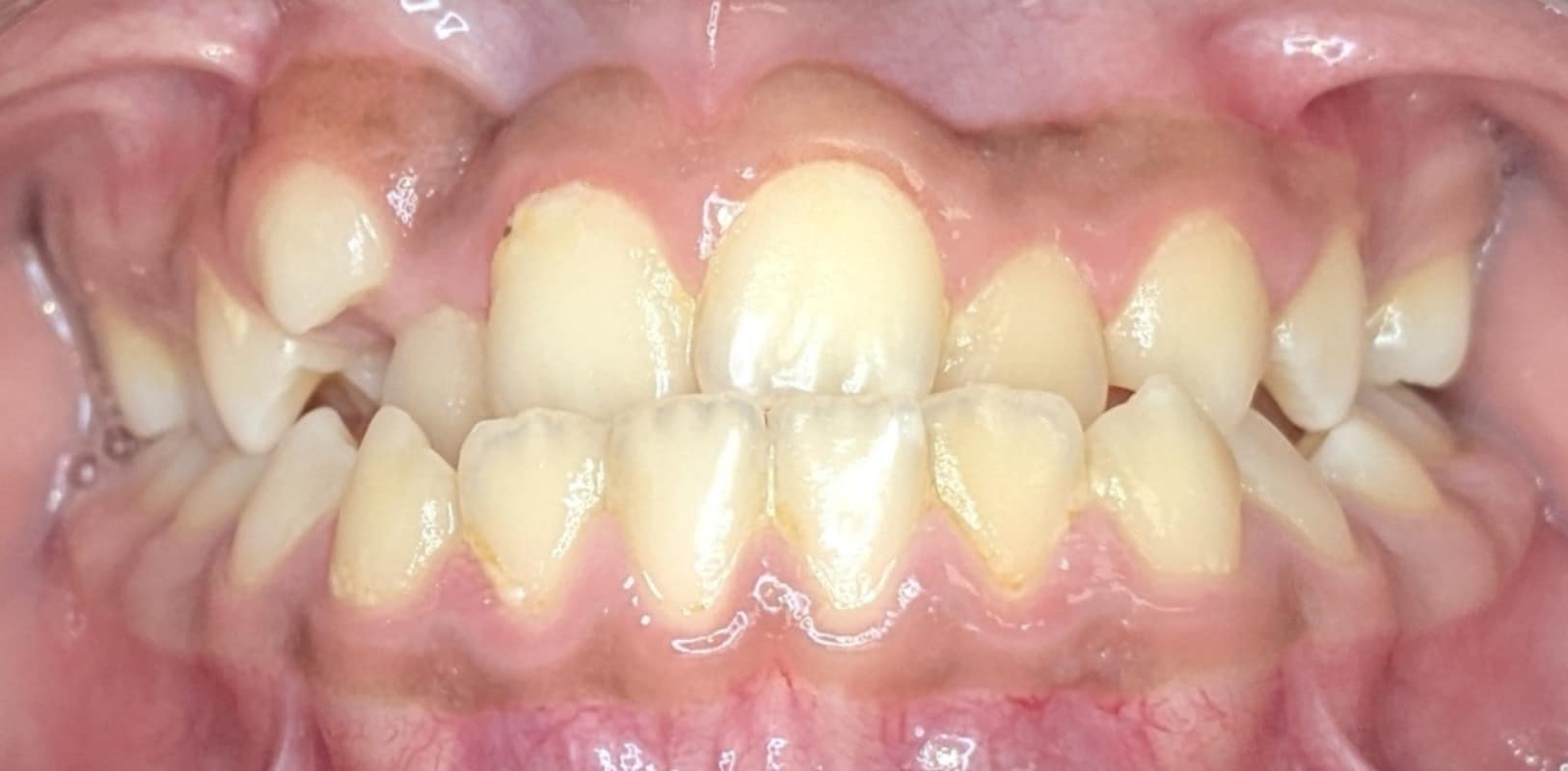 Metal braces 7 Before braces showing significant crowding and bite misalignment in new york orthodontic patient
